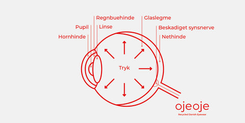 Grøn stær (glaukom)